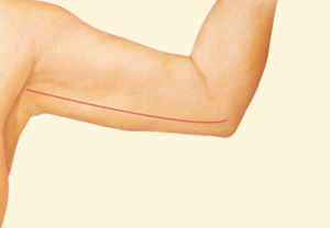 Arm after