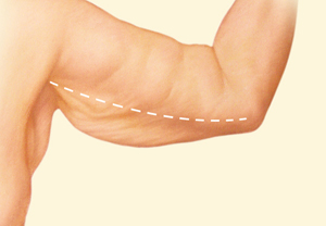 Arm before