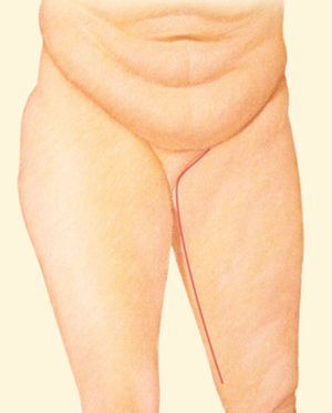 Body after