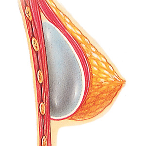 Breast after