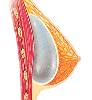 Breast after