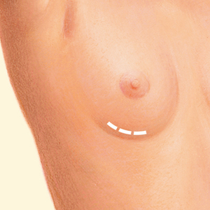 Breast before