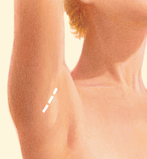 Breast before