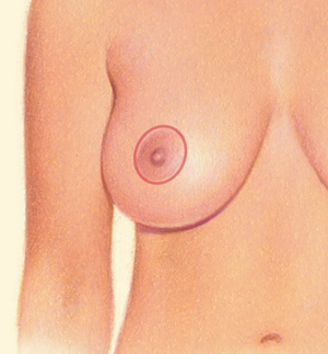 Breast after