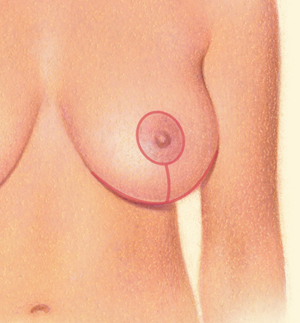 Breast after