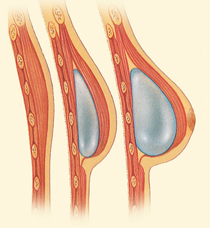 Breast before