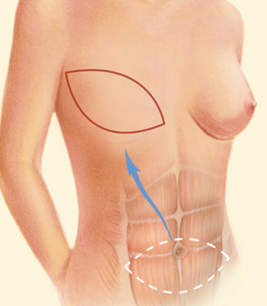 Breast before