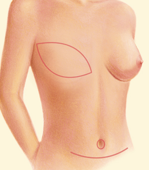 Breast after