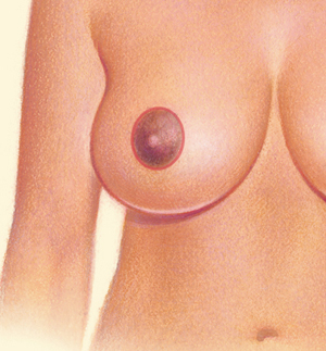 Breast after