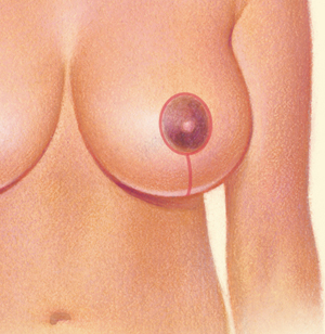 Breast after