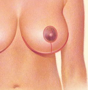Breast after