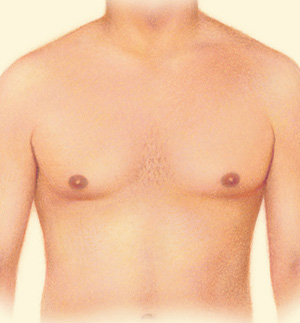 Breast after