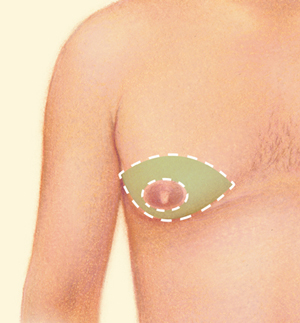 Breast before