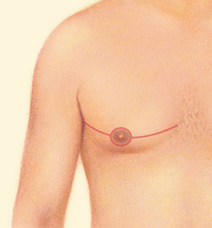 Breast after