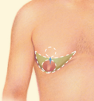 Breast before
