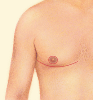 Breast after