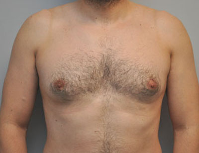 Breast before