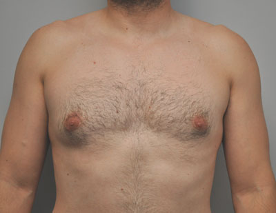 Breast after