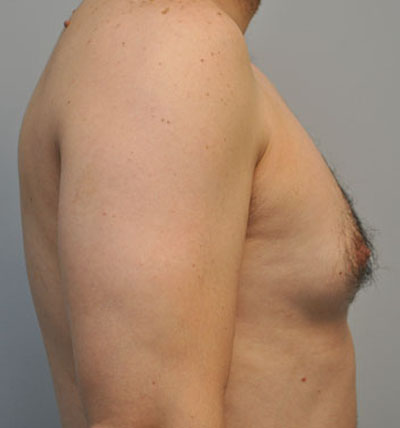 Breast before