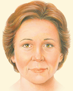 Brow after