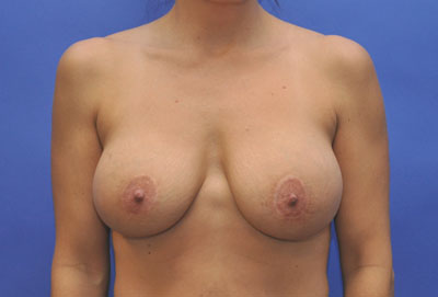 Breast before