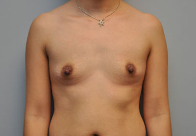 Breast before