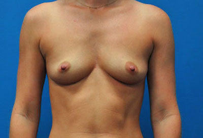 Breast before