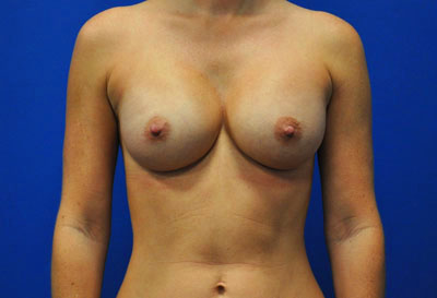 Breast after