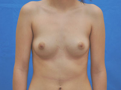 Breast before