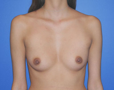 Breast before