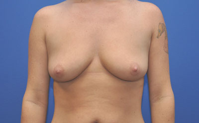 Breast before