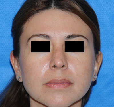 Nose before