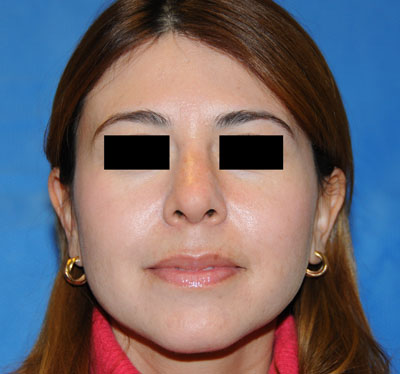 Nose after