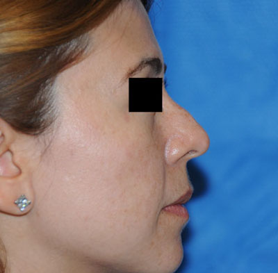 Nose before