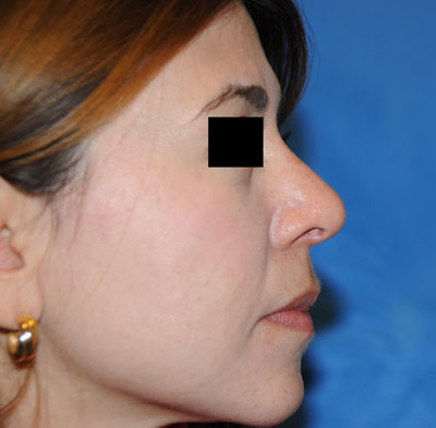 Nose after