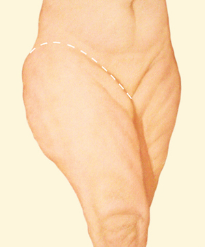 Leg before