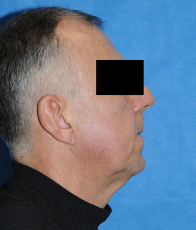 Face before