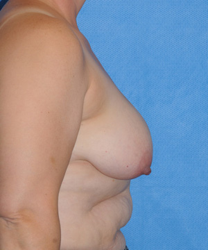 Breast before