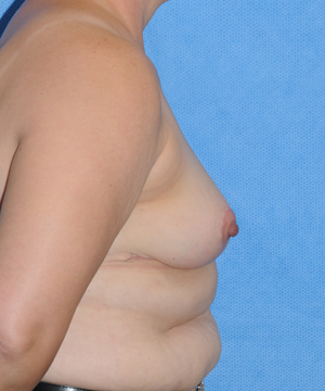 Breast after