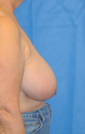 Breast before