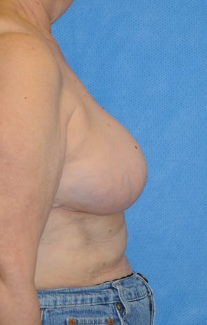 Breast after