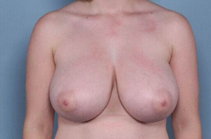Breast before