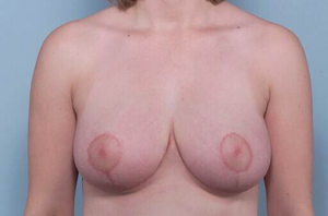 Breast after